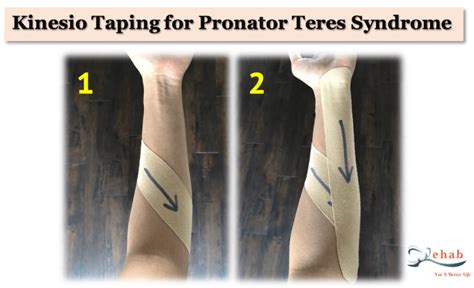 treatment for pronator teres syndrome